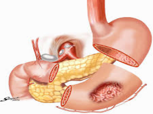 Laparoscopic Surgery for GI Cancers  KNOW MORE