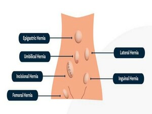 Laparoscopic Hernia Surgery KNOW MORE