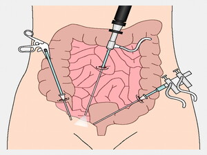 Laparoscopic Colorectal Surgery KNOW MORE