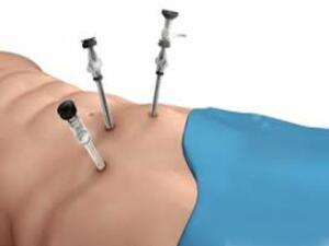 Laparoscopic Foregut Surgery KNOW MORE