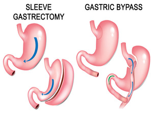 Bariatric and Metabolic Surgery KNOW MORE